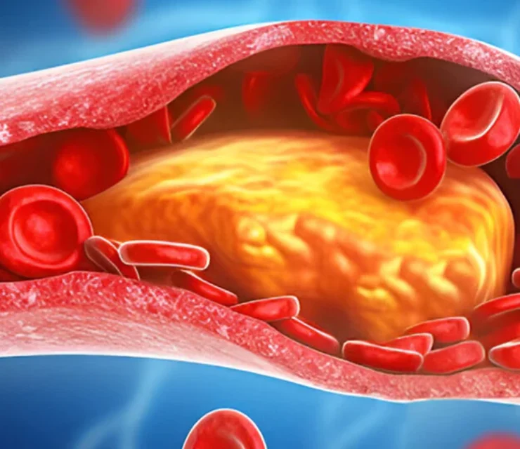 Obicetrapib slashes LDL cholesterol byover 30% in high-risk heart patients