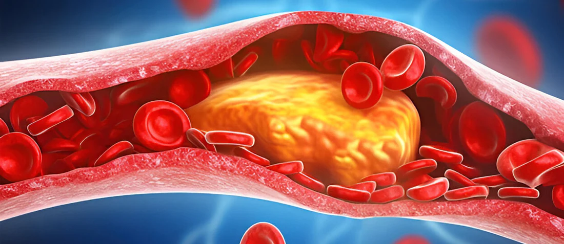 Obicetrapib slashes LDL cholesterol byover 30% in high-risk heart patients